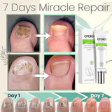 Flyles™Nail Repair Treatment Gel